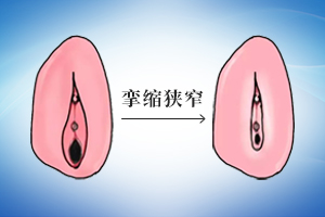贵阳萎缩型外阴白斑医院